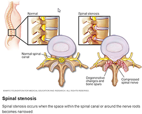 Spinal Stenosis