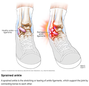 Sprain Ankle