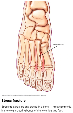 Stress Fracture