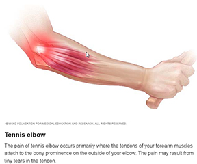 Tennis Elbow