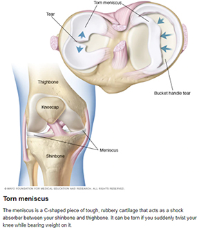 Torn Meniscus