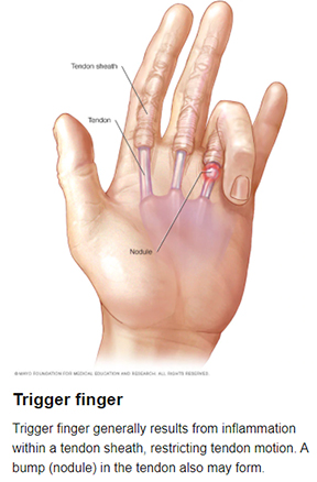 Trigger Finger