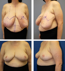 Breast reduction before and after