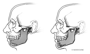 chin surgery or genioplasty