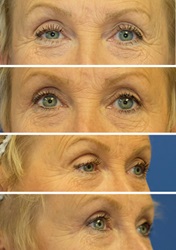 Eyelid lift before and after