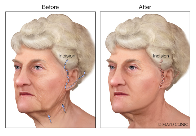 face-lift technique