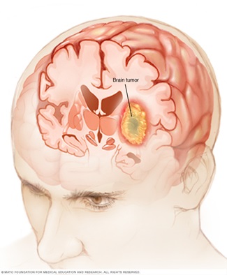 Brain tumor illustration
