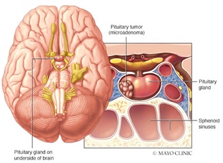 Pituitary tumor