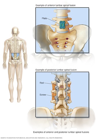 Spinal Fusion Lower Back